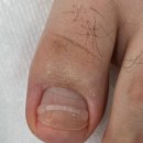 레푸스인하대역점 내성발톱 무좀발톱 발각질 문제성발 이미지