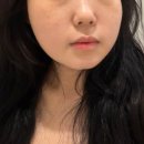 조아피부과의원 | 부산 윤곽주사 브이올렛 내돈내산 후기, 덕천동 피부과