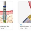 이노바이오써지 네이버블로그