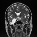 지주막낭종 (arachnoid cyst) 이미지