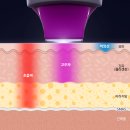 정진성 | 해운대 장산역 리프팅? 초음파 &amp; 고주파 리프팅의 차이점