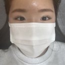 인모드 이중턱 멍 /청담 인모드fx 솔직후기