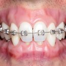 연세진정한치과의원 | 드디어 나만의 치아를 찾았다! 연세 유 앤 아이치 과 방문 후기