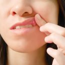 입 안의 불청객 ‘구내염’, 예방법은 있나? 이미지