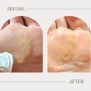 내손1동주민센터 | [굳은살/발 각질 Before &amp; After 후기✨]