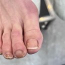 문제성 손, 발 오감네일 이미지