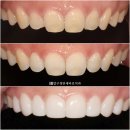다우치과의원 | 무삭제라미네이트 젤라미 타원형 앞니 절단치간공극앞니8개 치료 후기 기록