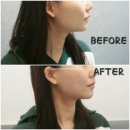 에르샤몽의원 | 동탄피부과) 에르샤몽의원 동탄점 - 브이로리프팅 후기