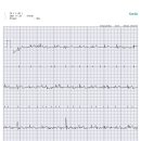 휴대용 심전도 Cardia측정과 병원12극 심전도 비교체험 이미지