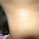 해미소한의원 | [아토피전문, 해미소한의원]아토피 치료후기