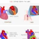 심부전 증상 원인 이미지