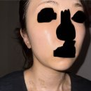 안지약국 | 편평사마귀 제거후기 DAY 12일차 •피부상태 및 관리방법