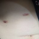 예사랑의원 | 담낭제거수술