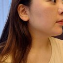 필업 | 신사피부과 팔자주름 콜라겐주사 필업 추천드려요 (효과 후기)