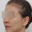 우리소프트 | Silhouette Soft(1편) 실루엣소프트 후기, 리프팅 효과?