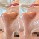 꿀벌상가 | 행신 피부관리 일산 에스테틱 꿀벌스킨앤바디 블랙헤드 피지