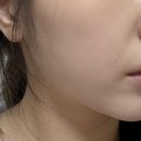 페이스라인 - 청주시 서원구 예체로 81 | 청담피부과 하이퍼 티타늄리프팅 효과 | 페이스라인 변화 후기