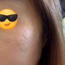 송스샵 | [화정역 송스뷰티 멜라닌케어 후기] 10년 된 기미와 쥐젖, 드디어 안녕했어요✨