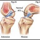 전십자인대(anterior cruciate ligament) 이미지