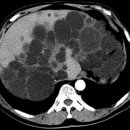 간낭종[hepatic cyst] 이미지