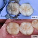아이엠치과기공소 | 10대 환자의 깊은 어금니 신봉동 치과 충치 치료 사례