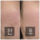 강남의원 | 강남 지우의원 후기 Q&amp;A｜여드름색소침착 레이저 통증, 변화, 주의사항