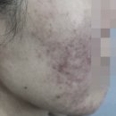 대전지루성피부염 치료 한의원 없이도 가능할까요