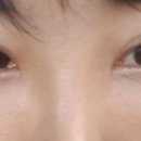눈밑 지방 재배치 3회차 후기. 이미지