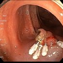 [하부위장관] Juvenile polyp case 2례 이미지