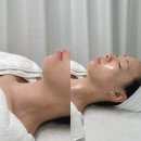 서울 에스테틱 | 서울에스테틱 성수 리프팅 6만줄 후기(오글로시 마이크로웨이브 턱라인 변화/가격)