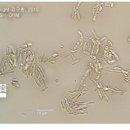 렌즈삽입술 16년차 부작용 저같은 분 있나요 이미지