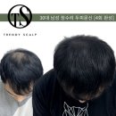 오직 스칼프 | 천호두피문신 고민 끝에 선택한 트렌디스칼프 후기