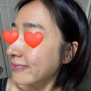 연세중앙의원 | 영월 연세의원:: 잡티제거 받은 후기!