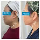 위례 피부관리 예지미뷰티, 알테온으로 무너진 얼굴선 주름 한번에 예뻐지자(내돈내산 강력추천)