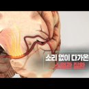 소리없이 다가온다 소혈관 질환 이미지