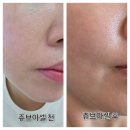 청담피부과 스킨부스터 요즘 핫한 쥬브아셀 8% 6CC 후기 및 가격까지 전부!!