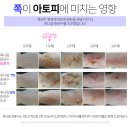 아토피 치유에 도움을 주는 푸른 빛 이미지