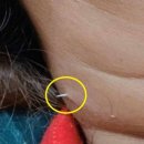 가시 살이 이미지