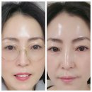 인셀덤 블리쥬 피부개선 패키지 후기[50대 서ㅇ경님]