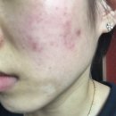리유한의원 주사피부염 피부 심부재생치료 후기