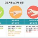 손가락 류마티스 관절염 증상 원인 검사 이미지