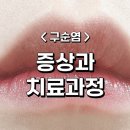 (주)셀텍 | 구순염:) 증상 및 1년동안의 치료과정, 현재상태