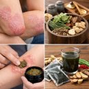 광산구-105 | 피부건선치료 피부건선연고 찾는다면 광산구건선 무료샘플로 먼저 확인해보세요