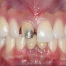 선이아름다운치과의원 | 광교치과 티나는 앞니 크라운 교체, 금속 기둥 제거부터 잇몸 성형, 아름다운 지르코니아 제작까지