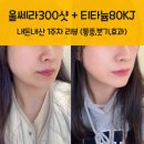 에이치프라임외과의원 | 수유피부과, 울쎄라프라임300샷 + 티타늄리프팅80Kj 찐후기(통증,가격,효과,붓기)