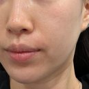 건지공원 내 (83번) | 청담피부과 포트라리프팅 리쥬란 피더린 재생 관리 후기 도산대로 도산공원