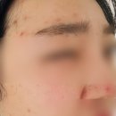 정환교피부과의원 네이버블로그