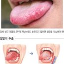 설암 초기 설암 원인 설암 이미지