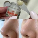 현지피부관리 | 악센다 루티너 사용법 예비신랑 피부관리 모공 블랙헤드 내돈내산 후기