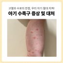 수포차 | 고열과 수포 전쟁! 돌아기 수족구 증상, 어른 수족구 전염 후기